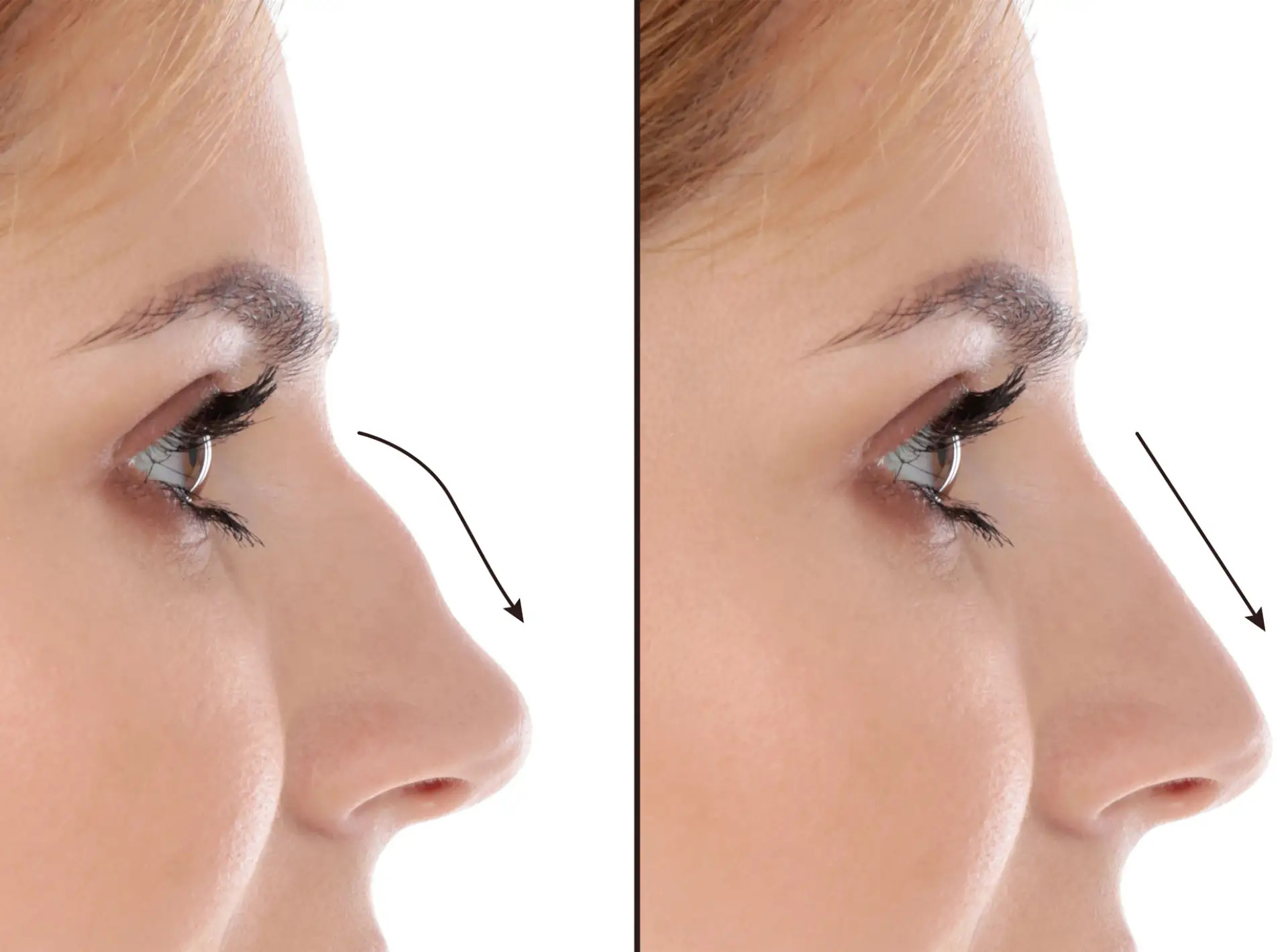 Sculpting Perfection: Advanced Rhinoplasty in Dubai