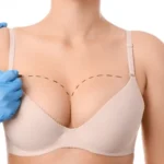 Breast Augmentation in Islamabad