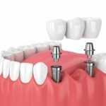The Rise of Same Day Dental Implants