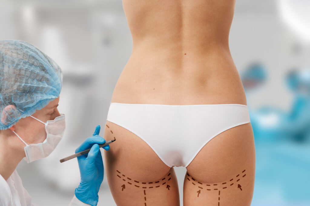 woman marked out cosmetic surgery 2