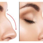 Top Rhinoplasty Surgeon in Pakistan