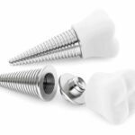 imgi 21 dental implants