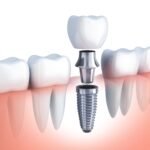 implant-diagram (1)