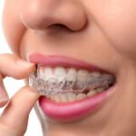 teeth braces in Jaipur