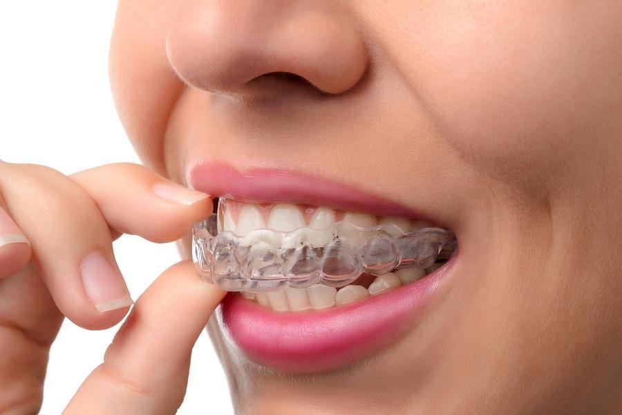 Where to Get Teeth Braces in Jaipur