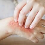 Natural Treatments for Bullous Pemphigoid
